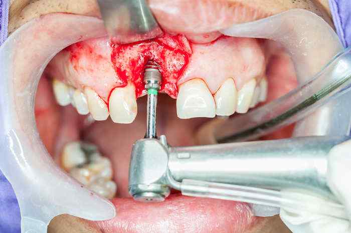 implantaciya-zubov2