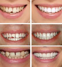 zubnoj-protez-dlya-lyudej-s-polnym-otsutstviem-zubov-e1514722201686